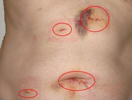 laparoscopy scars